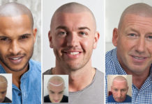 Great Tips for Treating Hair Loss in Men