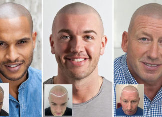 Great Tips for Treating Hair Loss in Men