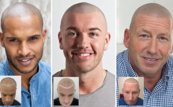 Great Tips for Treating Hair Loss in Men