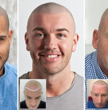 Great Tips for Treating Hair Loss in Men