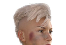 3 Home Remedies for Bruises