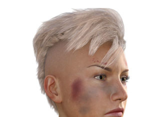 3 Home Remedies for Bruises