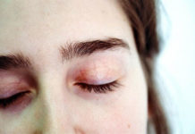 Saying Goodbye to Aging, Wrinkled Skin: 3 Non-Surgical Anti-Ageing Treatments