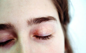 Saying Goodbye to Aging, Wrinkled Skin: 3 Non-Surgical Anti-Ageing Treatments