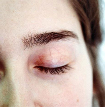 Saying Goodbye to Aging, Wrinkled Skin: 3 Non-Surgical Anti-Ageing Treatments