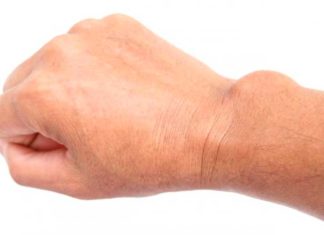 Ganglion Cyst Causes & Treatment