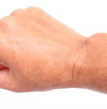 Ganglion Cyst Causes & Treatment