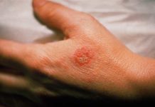 Eczema Causes & Treatment Tips