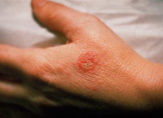 Eczema Causes & Treatment Tips