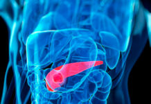 Pancreatic Cancer to Be Treated with Modified Smallpox Virus