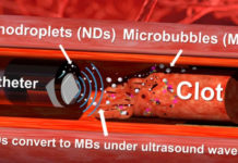 Ultrasound Drill and Nanodroplets Remove Blood Clots from Arteries