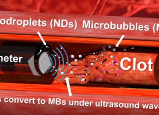 Ultrasound Drill and Nanodroplets Remove Blood Clots from Arteries