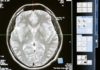 Remote Brain Surgery Made Possible